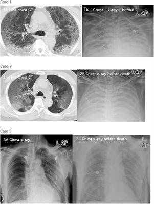 Low-to-Moderate Dosage and Short-Term Use of Corticosteroids Benefit Patients With Severe COVID-19 Infections